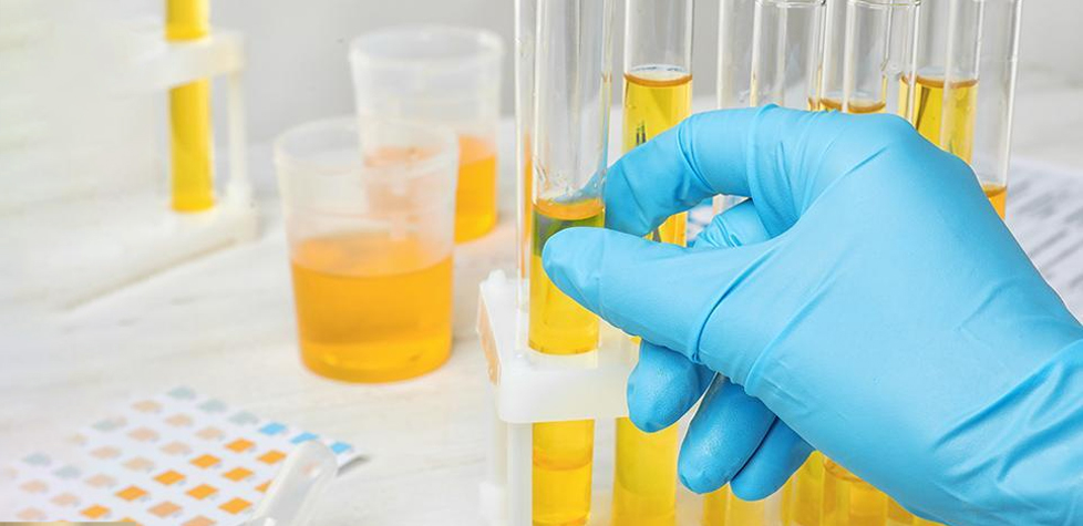 Os procedimentos para a realização do exame de urina no laboratório clínico