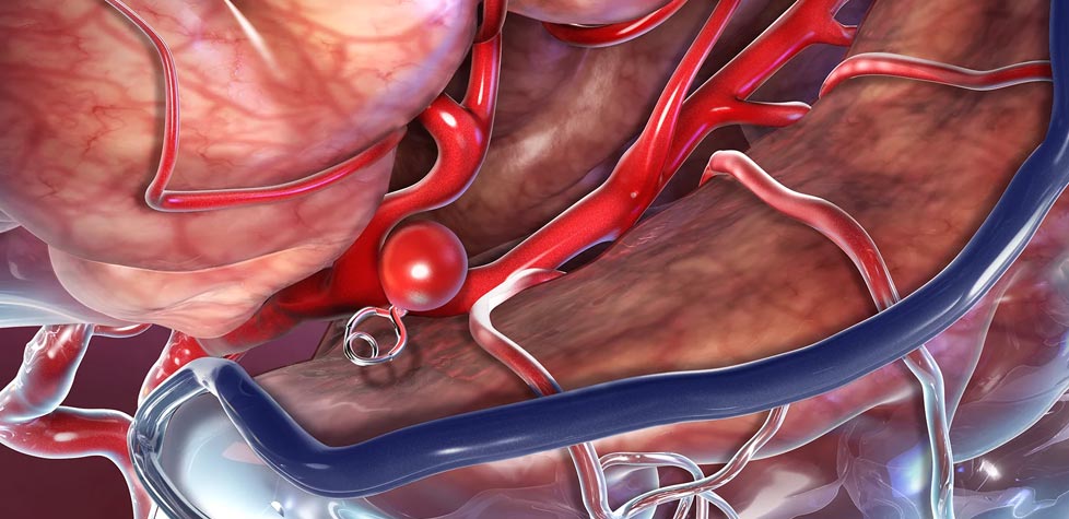 A Qualidade dos clipes para aneurisma intracraniano de fechamento automático