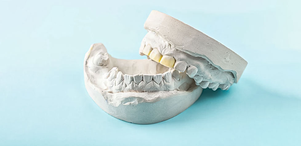 A classificação e as especificações dos gessos odontológicos