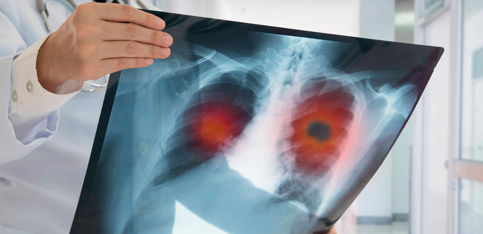 O câncer de pulmão é o quarto tipo mais frequente no Brasil
