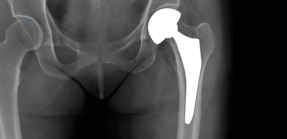 A resistência à fadiga por cisalhamento e por flexão dos implantes para cirurgia