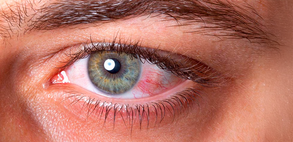 As diretrizes clínicas para as uveítes não infecciosas