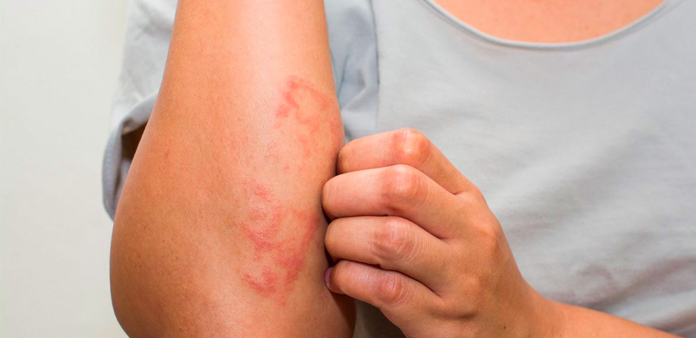 O protocolo clínico das dermatites atópicas