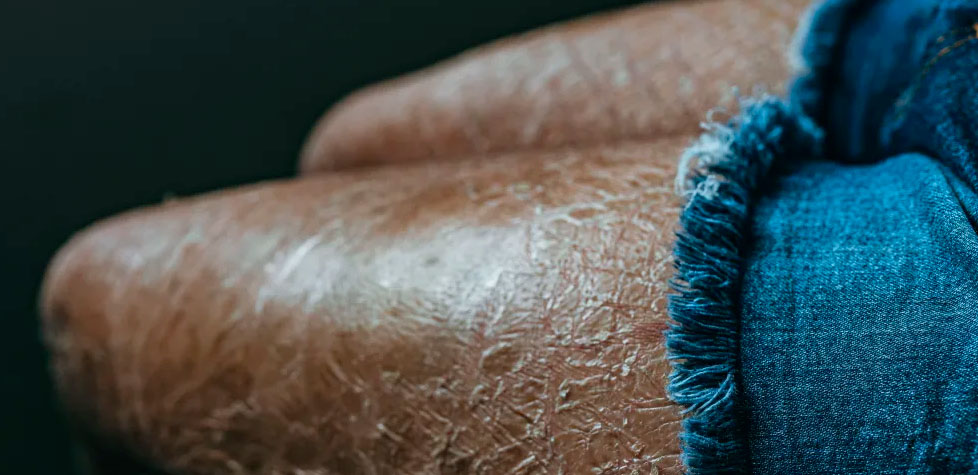 As diretrizes clínicas das ictioses hereditárias