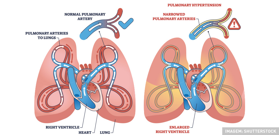 As terapêuticas clínicas da hipertensão arterial pulmonar