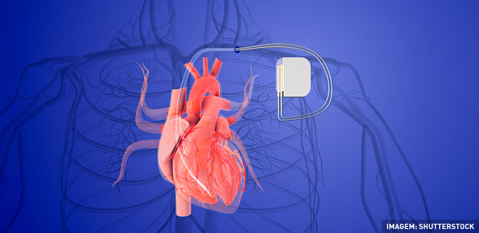 O protocolo do uso dos marca-passos cardíacos implantáveis
