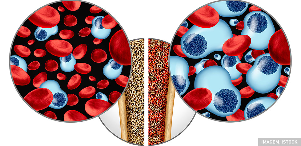 O mieloma múltiplo tem origem na medula óssea