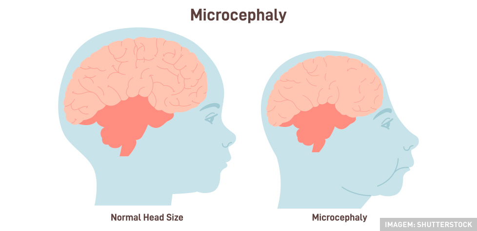 Saiba quando ocorre a microcefalia
