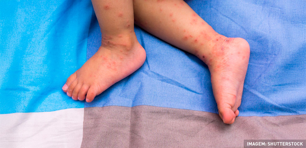 Os riscos clínicos da síndrome da rubéola congênita