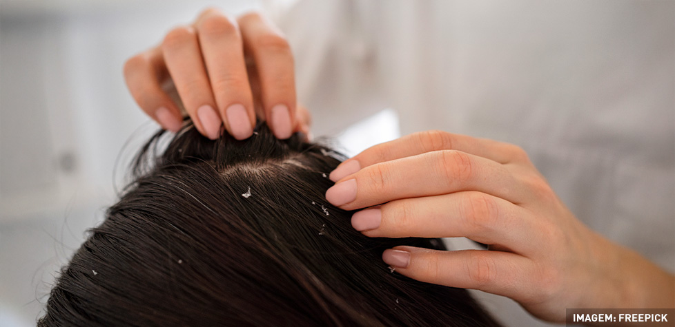 Os sintomas médicos da dermatite seborreica