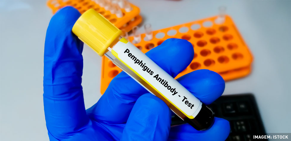 A manifestação clínica do fogo selvagem ou pênfigo