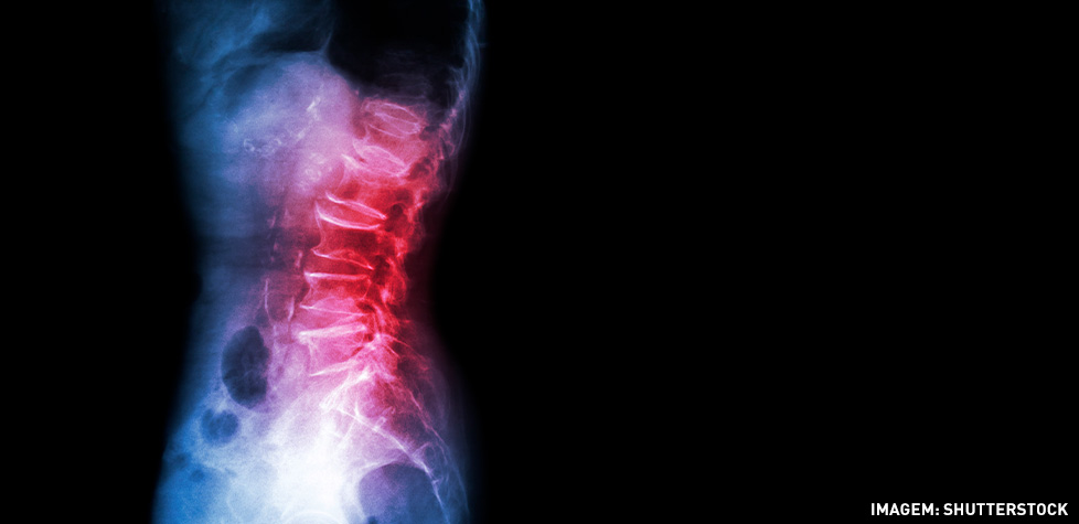 As manifestações clínicas do bico de papagaio