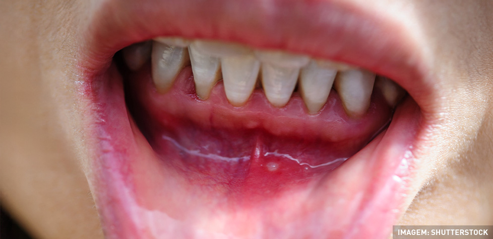 A inflamação da gengiva é chamada de gengivite