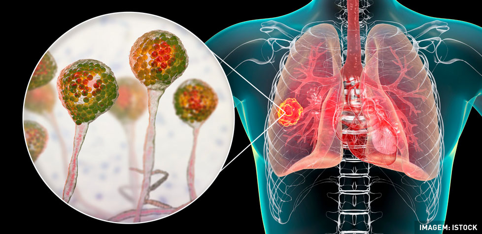 As causas médicas da zigomicose