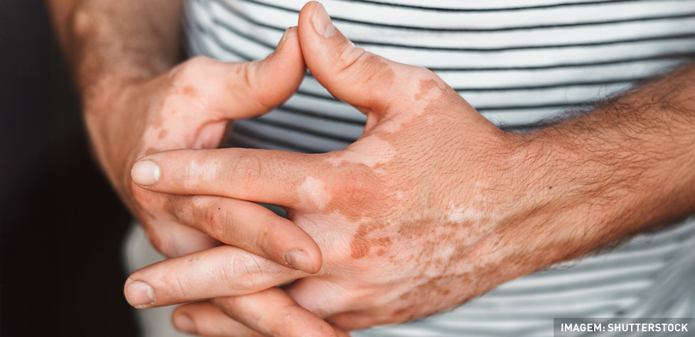 A doença de origem imunológica denominada vitiligo