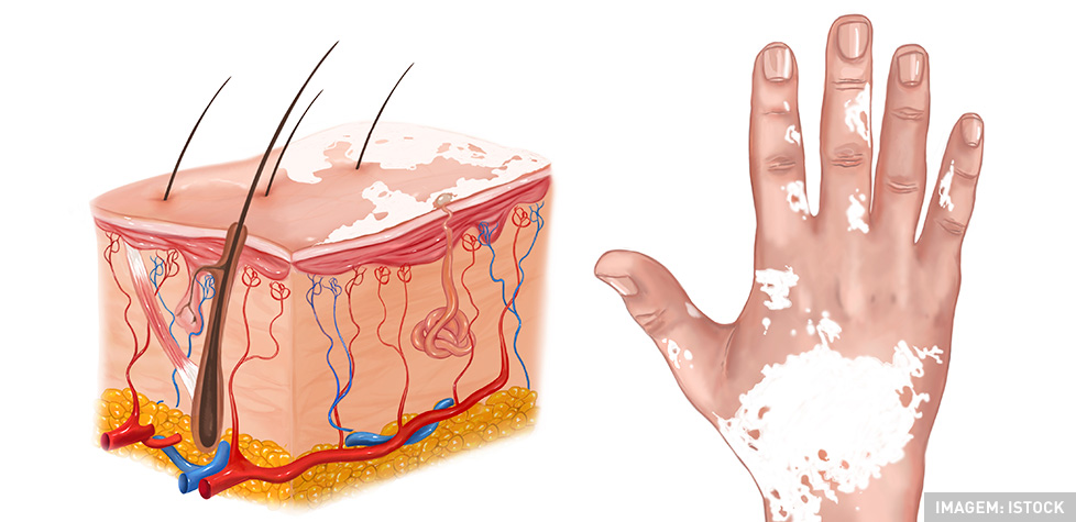 As causas médicas do xeroderma pigmentoso