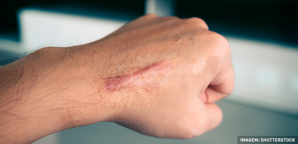 As características clínicas dos queloides