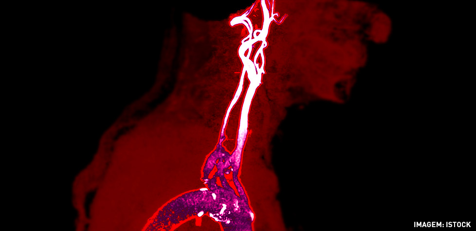 As causas clínicas da estenose da carótida