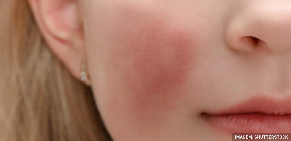 Os fatores que podem causar a rosácea