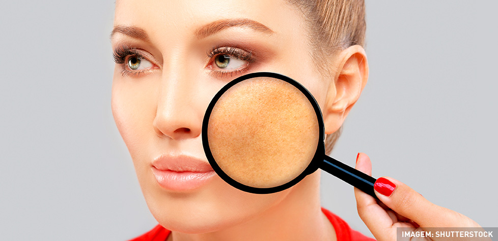 Os tratamentos indicados para o melasma