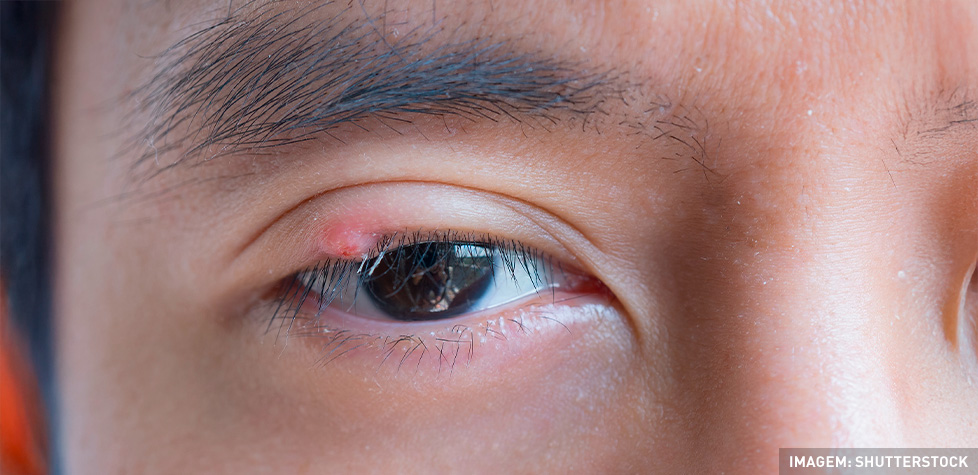 Os problemas causados pelo terçol