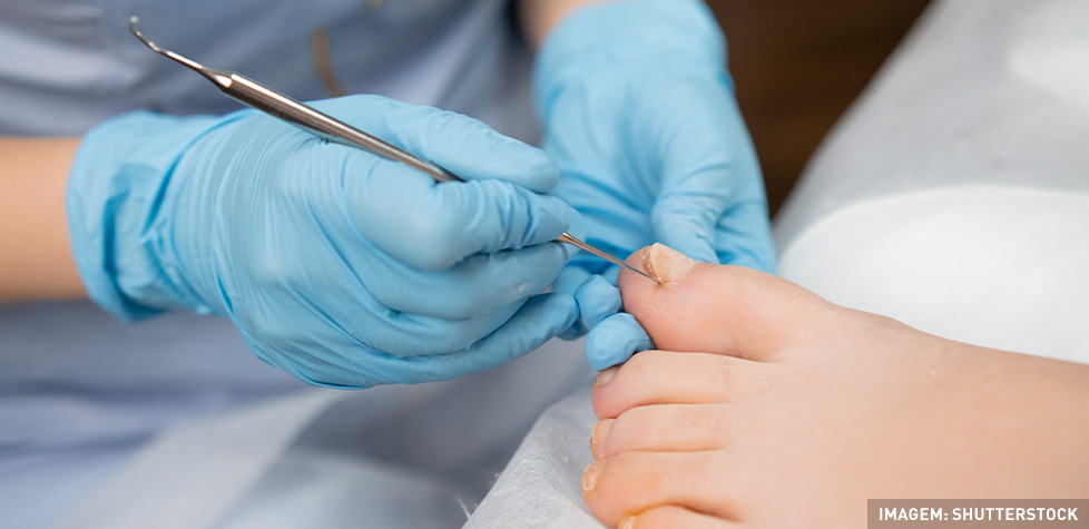 As condições clínicas da unha encravada