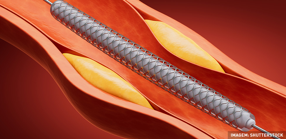 A avaliação da conformidade dos stents vasculares