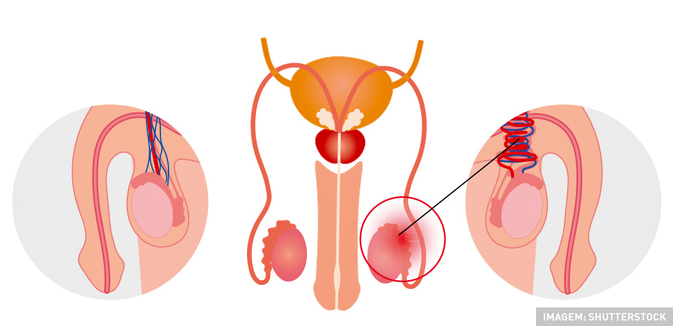  As causas clínicas da torção testicular