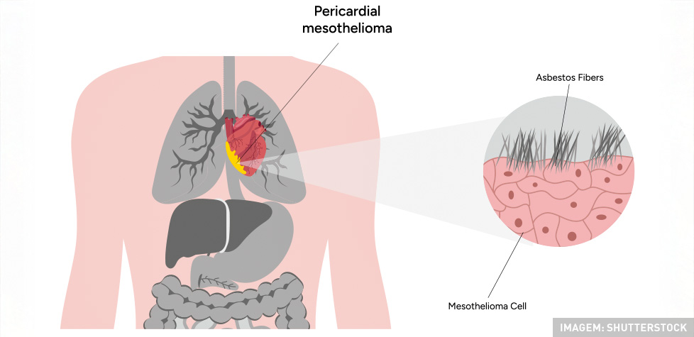 O mesotelioma e a asbestose são doenças causadas pelo amianto