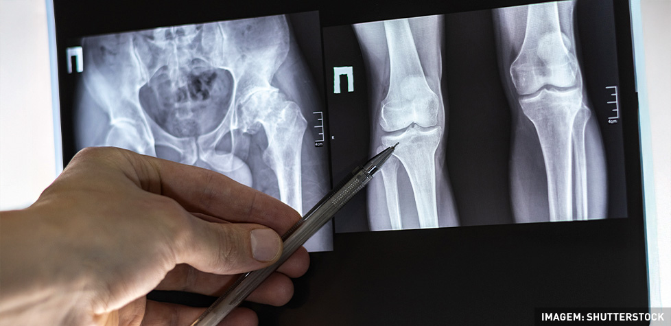 Os problemas médicos da coxartrose