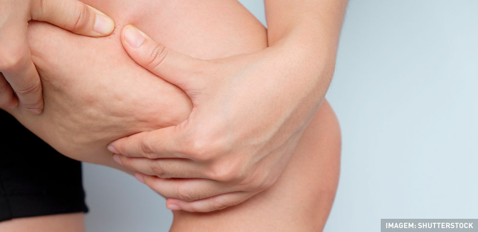 As causas medicas da celulite