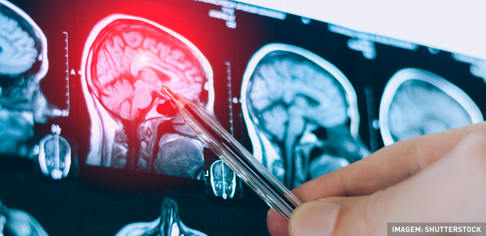 As causas clínicas dos aneurismas cerebrais