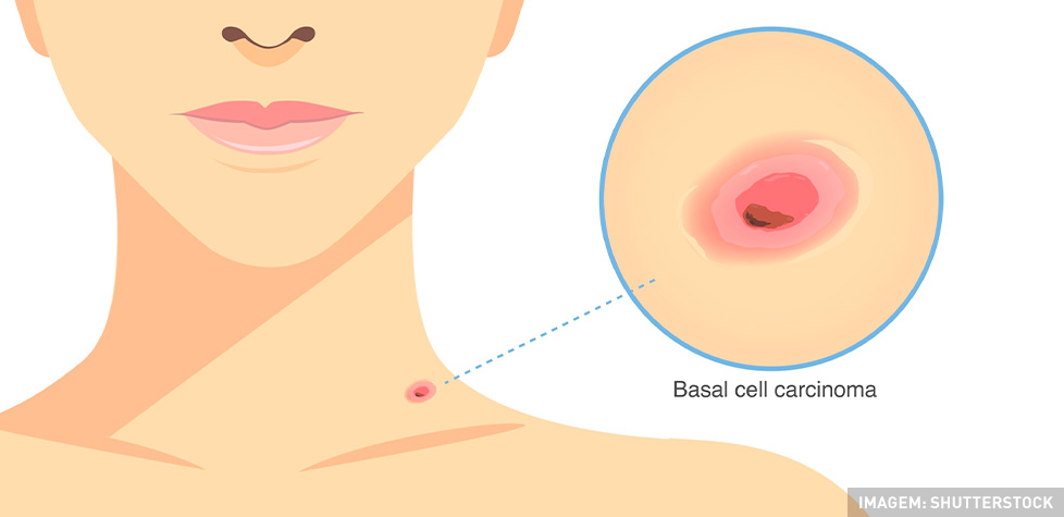 As complicações médicas do câncer basocelular