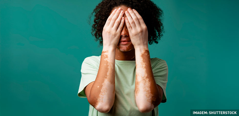  As causas médicas do vitiligo
